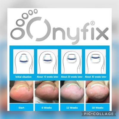 Onyfix help prevent/stop ingrown growth/pain