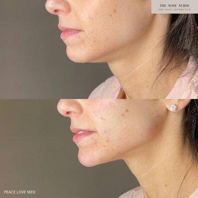 Chin filler can help elongate your face, define your jawline, while giving you an overall slimmer facial appearance!