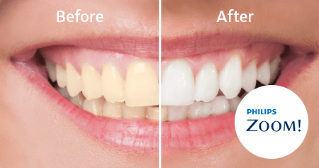 Zoom Whitening