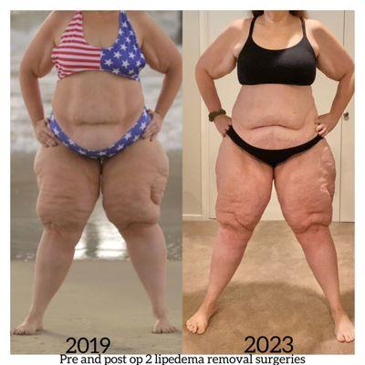 Before and after 2 Lipedema removal surgeries