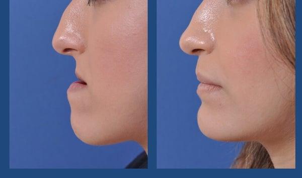 Before & After (Orthognathic Surgery case )