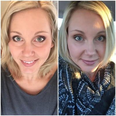 Pre-Dr. Biesman visit (under eye circles and smaller upper lip) vs. post- Dr. Biesman with 2 syringes of Restylane Silk dermal filler.