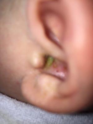 This is what my sons ear looked like BEFORE I took him to see Lisa Bork at right time. Surely this does not look like wax to me.