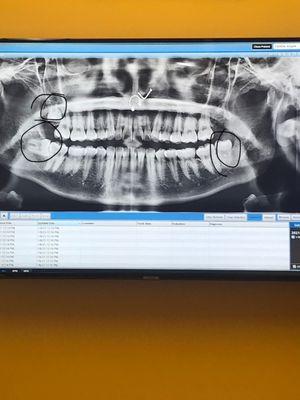 i also had an artificial bone graft bc of my impacted tooth