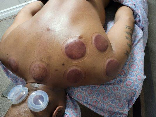 Cupping can assist with showing the therapist what is needed