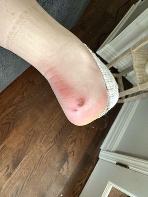 Ankle