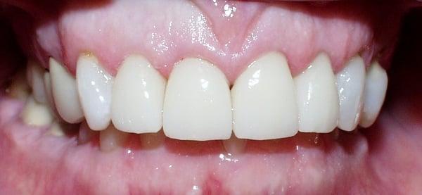 after veneers