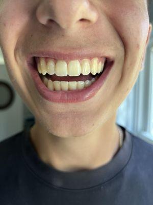 A great smile due to braces.