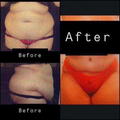 Tummy Tuck and lipo