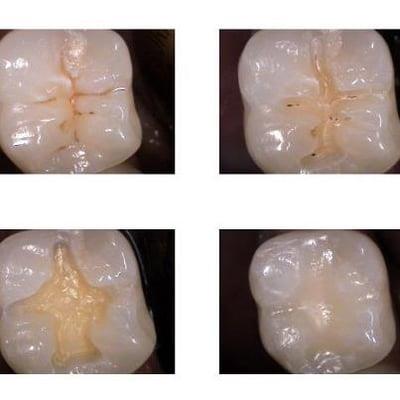 What appears to be a tiny cavity turned into a pretty large one!  What shape does that look like to you?