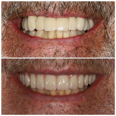 Dental Implant Makeover