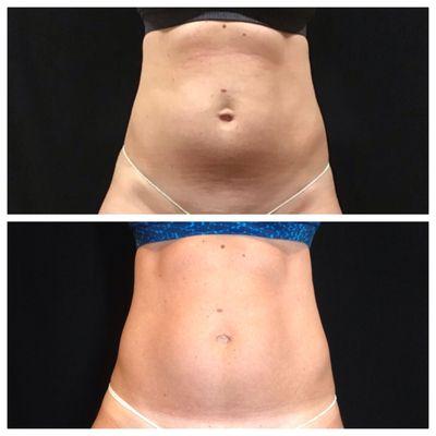 Body Contouring, Fat Reduction, Cellulite Treatment