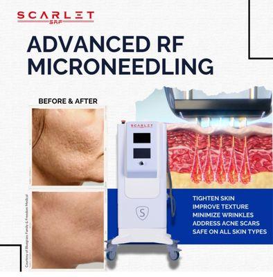 SCARLET SRF microneedling