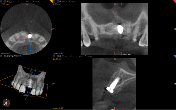 Dental CT images taken right during the implant placement surgery at Dr. Sayegh's office show the dental implant is in the correct position.