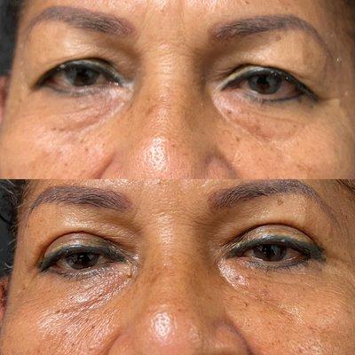 Before and After - Blepharoplasty