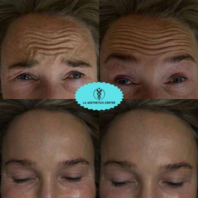 Most Common Region For Botox Treatments Making Those Forehead Wrinkles Disappear. Results 14 Days Post Treatment