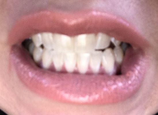 This is my After picture where you can clearly see my teeth are between a number 1-3 on the color chart! What a difference!