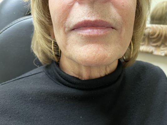 Before lip filler.