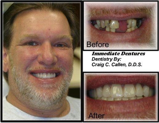 Immediate placement denture