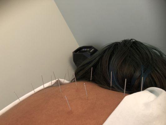 Back acupuncture to support pain release after chiropractic alignment