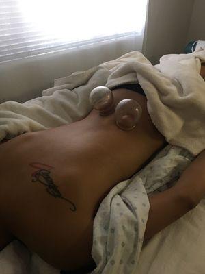 Lumbar and sciatica relief through cupping and acupuncture.