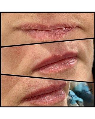 Lip filler with Juvederm!