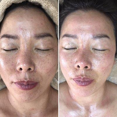 Before and after. Brightening treatment.