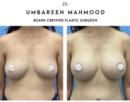 Breast augmentation with silicone implants