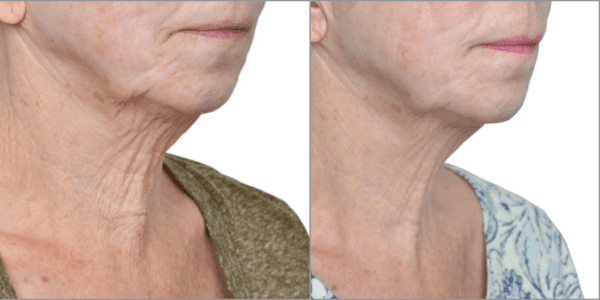 Skin Tightening before and after. After 8 sessions.