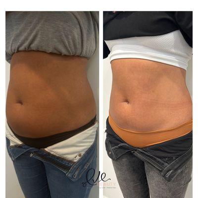 Body Sculpting using RF and Lipolysis