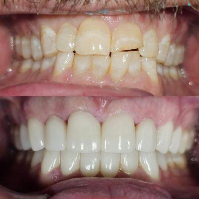 Porcelain Crowns / Veneers before and after