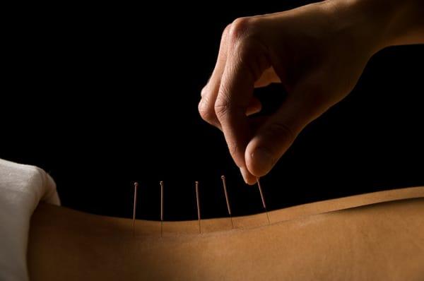 Acupuncture is a method of encouraging the body to promote natural healing and improve function.