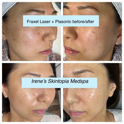 Fraxel laser and plasonic facials