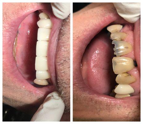 Before and After Smile design