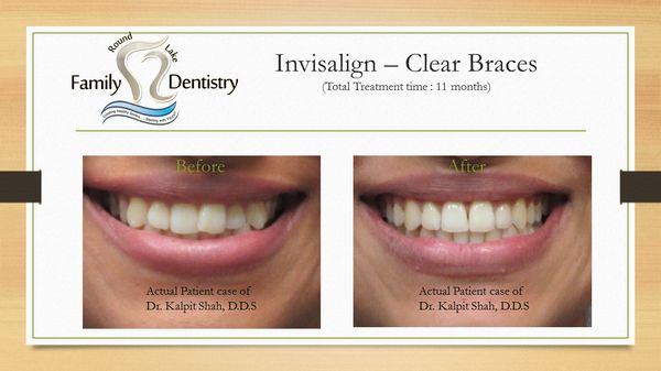 Invisalign B&A - Dr.Kalpit Shah