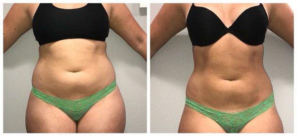 SCULPT - body contouring detox