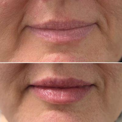 Lips enhancement