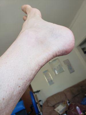 My busted Achilles tendon four and a half months after surgery.