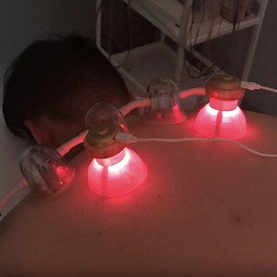 Cupping and E-Stim Therapy