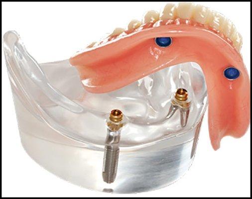 Implant Retained Dentures