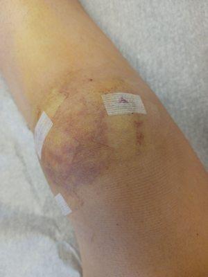 What my knee looks like now! It is recovering quite fast and the swelling is not too bad my doctor said! I guess I am so lucky.