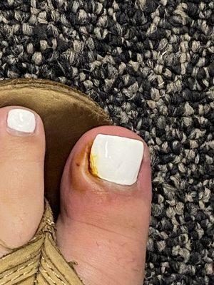 Infected toe nail from a SIMPLE pedicure.