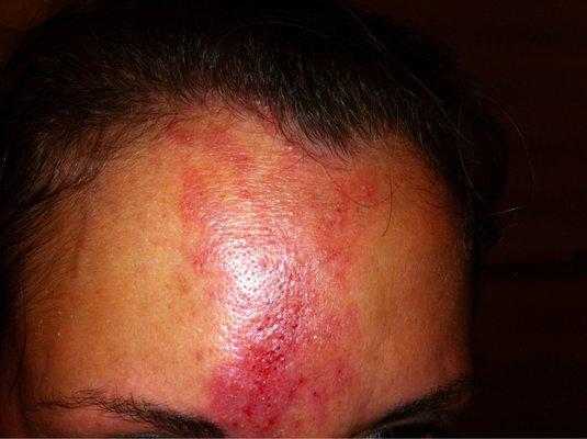 My forehead after Juvederm was injected between my eyes.