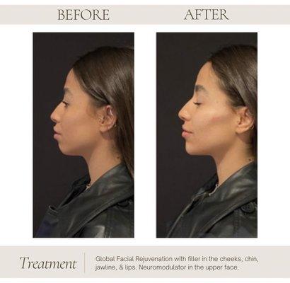 Before and after of global facial rejuvenation with dermal filler in the cheeks, chin, jawline, & lips. Neuromodulator to the upper face.