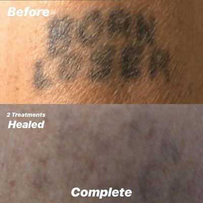 Older tattoo healed quickly and needed less treatments