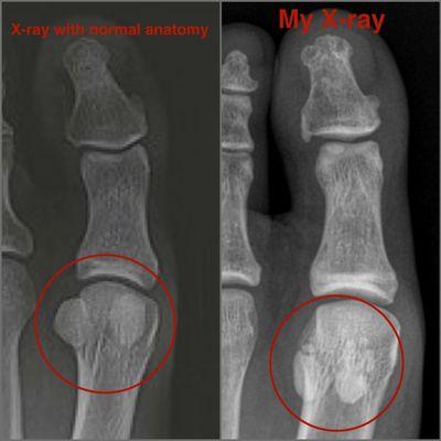 On the left is normal sesamoid anatomy. On the right is my sesamoid anatomy that the radiologist wrote was normal on the report.