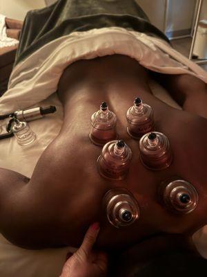 Cupping is primarily used to stimulate metabolic activity, improve circulation & immune function, decrease inflammation & pain.