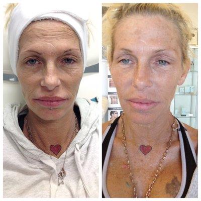 Before and after ONE Venus Viva Skin Resurfacing treatment! Reduce sun damage, fine lines, deep wrinkles and pigmentation! AMAZING TREATMENT