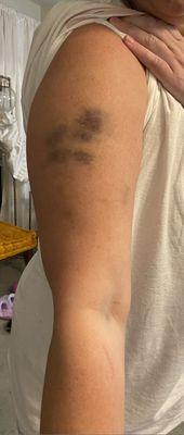 Bruises from Deputy Steven Davis - excessive force