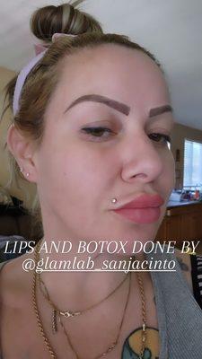 The best fillers and botox...